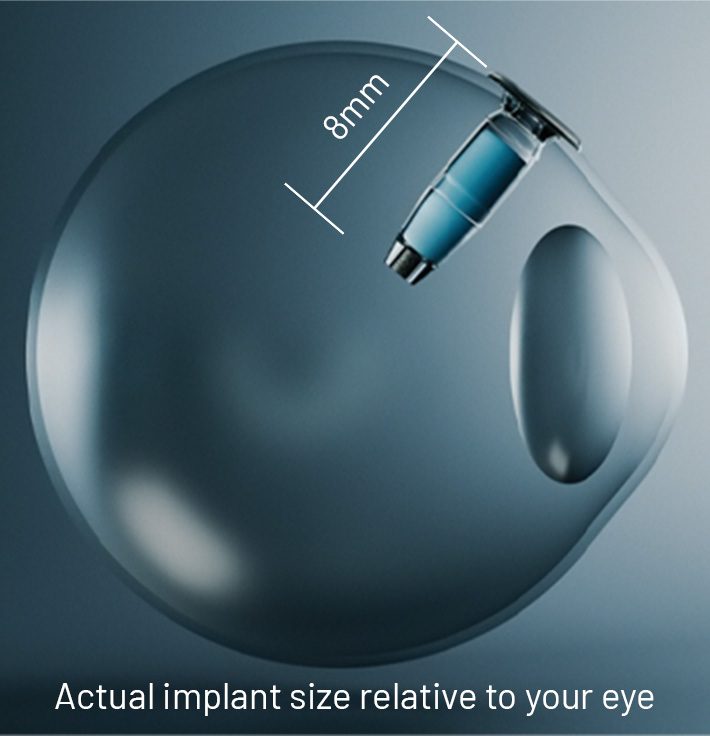 Slider infographic: Eye with implant